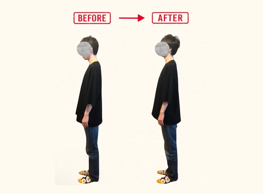 猫背改善 Before After